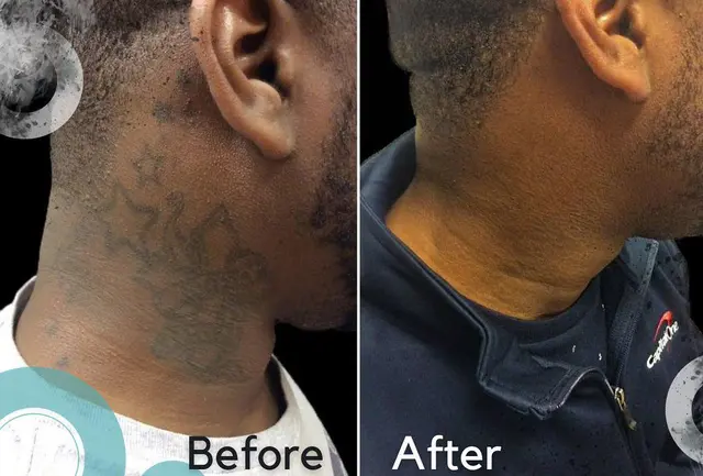 Removery Tattoo Removal & Fading — photo from the business 5