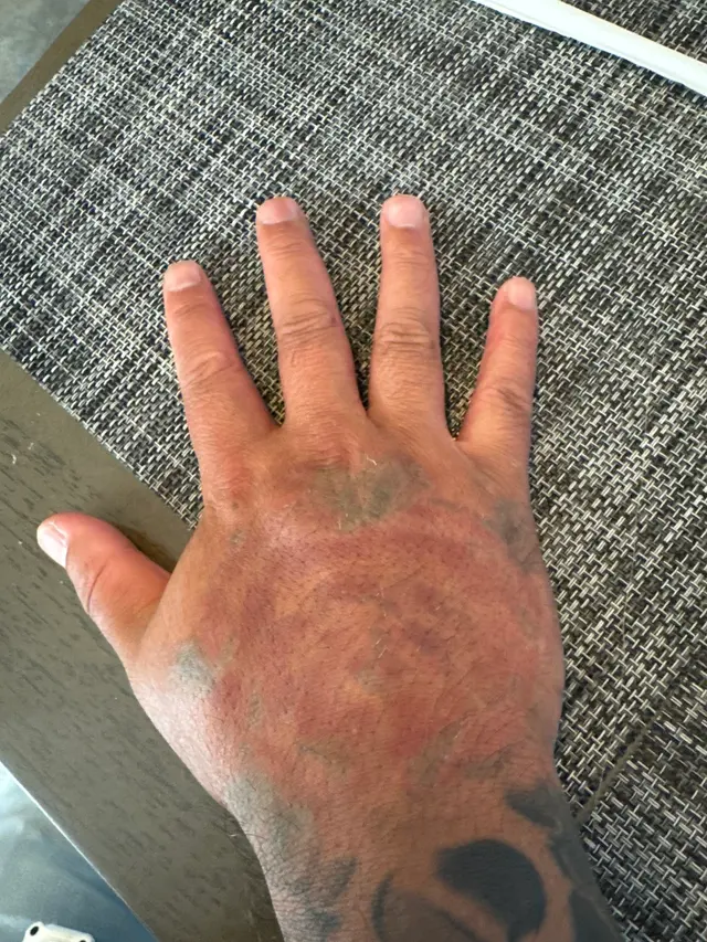 Customer photo of work by Removery Tattoo Removal & Fading, from Hean So's review