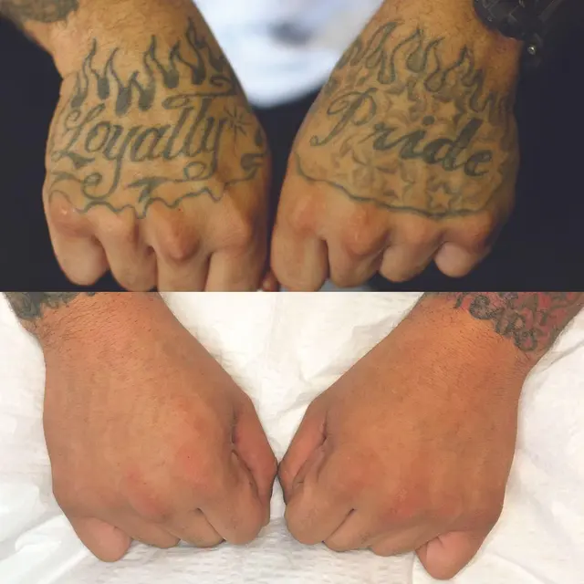 Removery Tattoo Removal & Fading — photo from the business 11