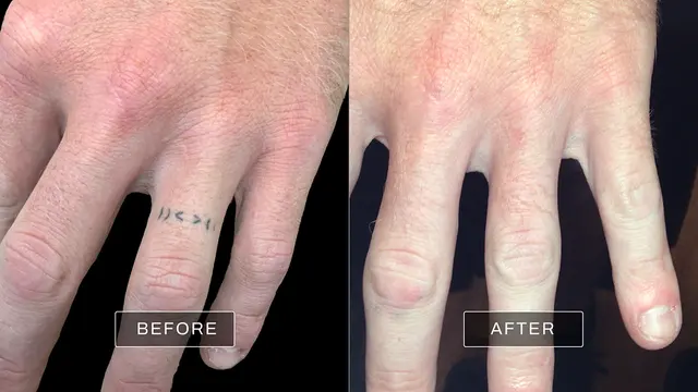 Removery Tattoo Removal & Fading — photo from the business 7
