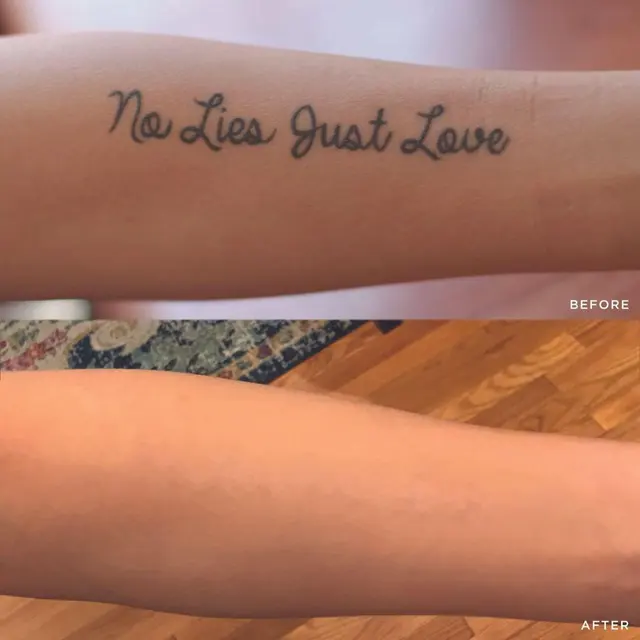 Removery Tattoo Removal & Fading — photo from the business 6