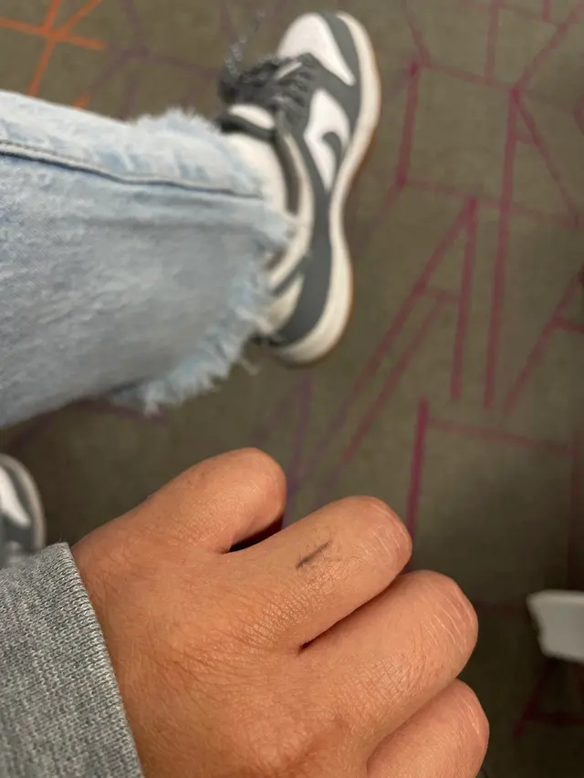 Removery Tattoo Removal & Fading — customer photo 8