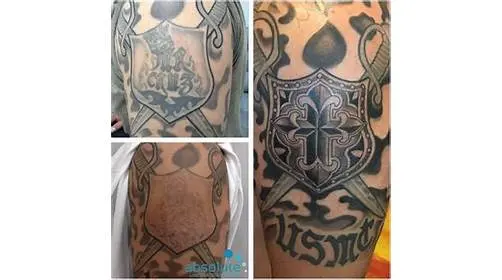 Removery Tattoo Removal & Fading — photo from the business 10