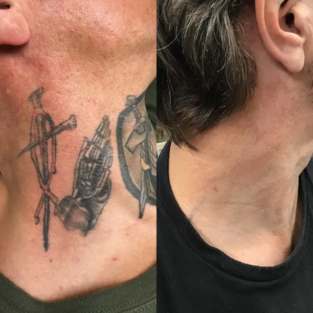 Removery Tattoo Removal & Fading — photo from the business 8