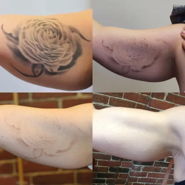 Removery Tattoo Removal & Fading — photo from the business 6