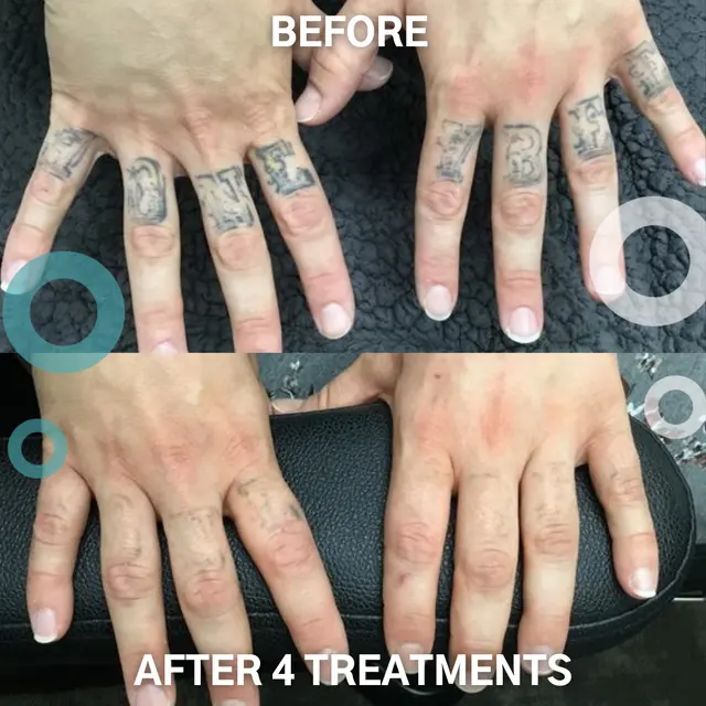 Removery Tattoo Removal & Fading — photo from the business 10