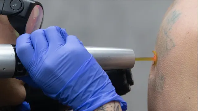 Removery Tattoo Removal & Fading — photo from the business 6