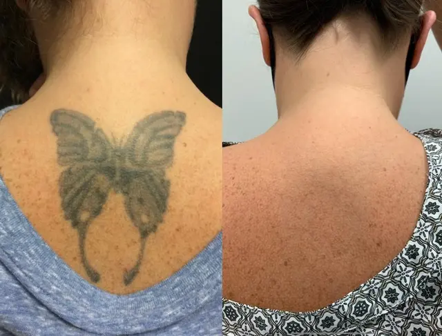 Removery Tattoo Removal & Fading — photo from the business 10