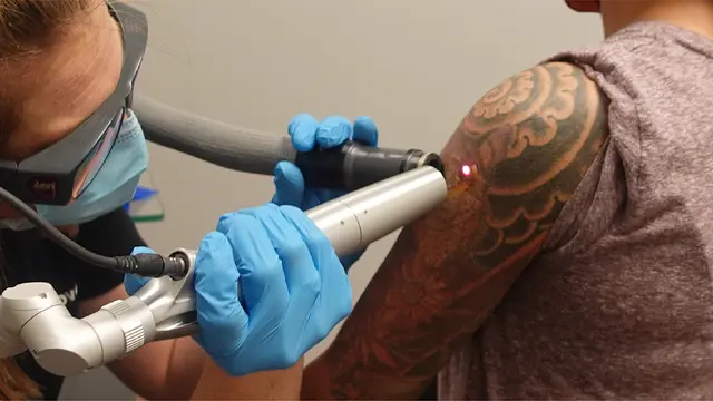 Removery Tattoo Removal & Fading — photo from the business 7