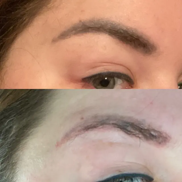 Deleted Scene Tattoo Removal — customer photo 3