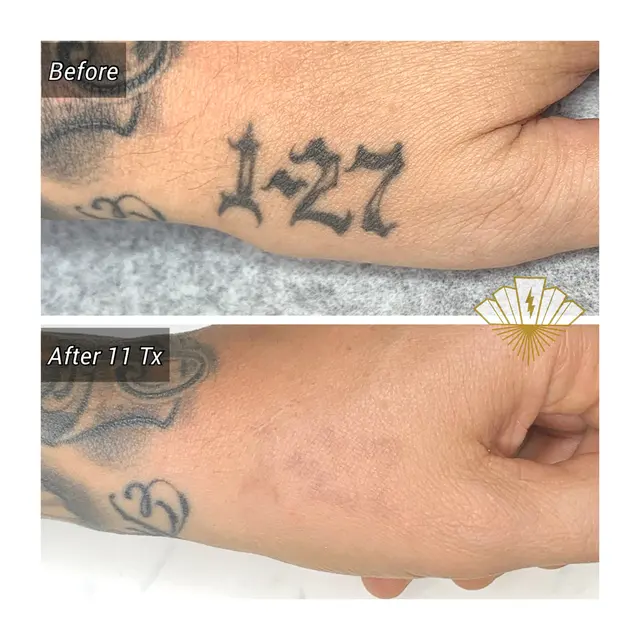 Deleted Scene Tattoo Removal — photo from the business 5