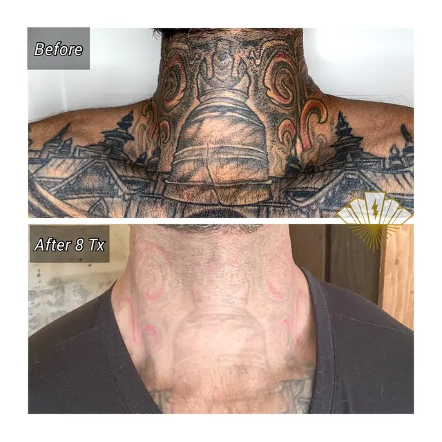 Deleted Scene Tattoo Removal — photo from the business 9