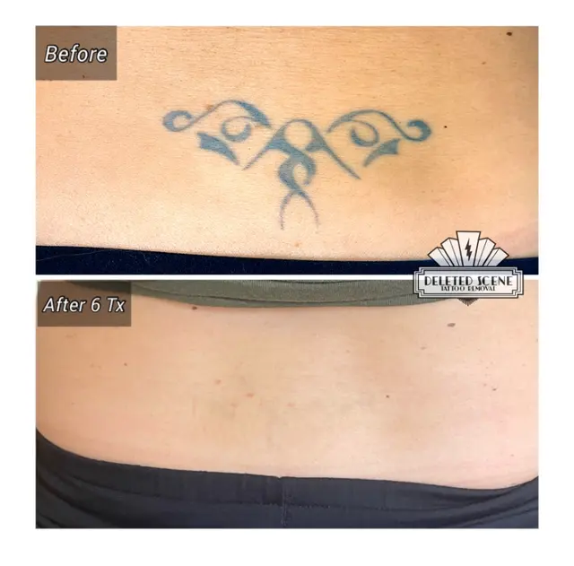 Deleted Scene Tattoo Removal — photo from the business 8