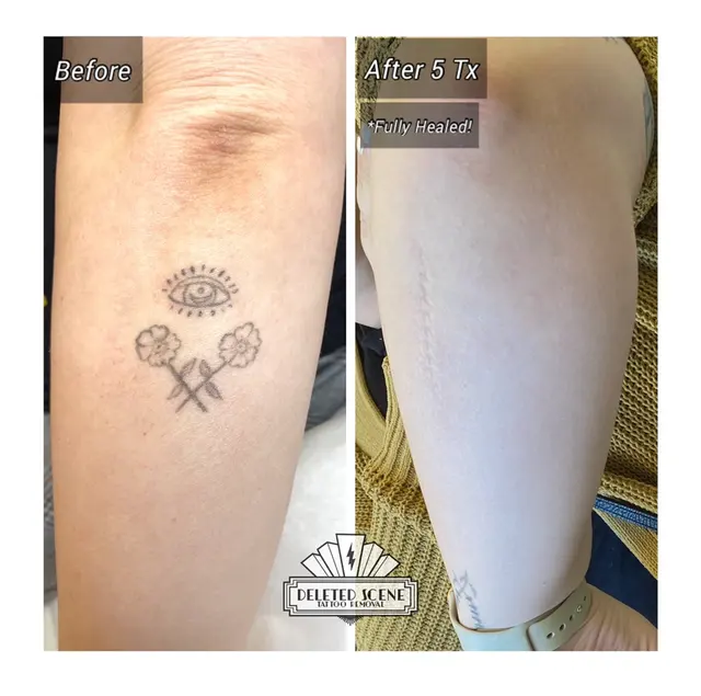 Deleted Scene Tattoo Removal — photo from the business 6
