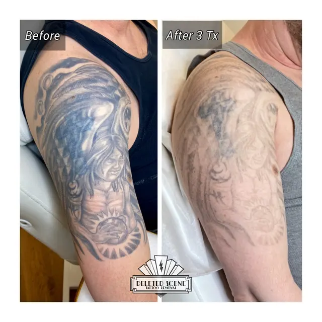 Deleted Scene Tattoo Removal — photo from the business 10