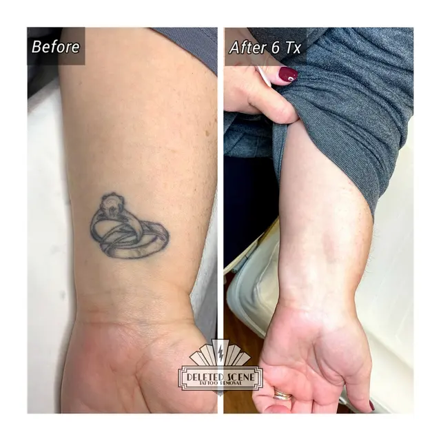 Deleted Scene Tattoo Removal — photo from the business 4
