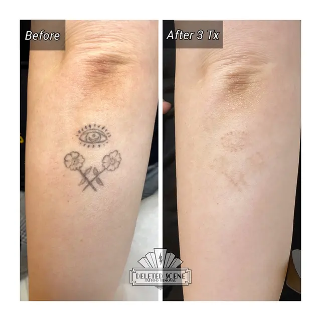 Deleted Scene Tattoo Removal — photo from the business 11