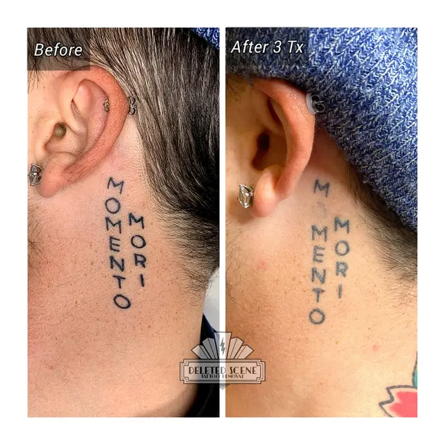 Deleted Scene Tattoo Removal — photo from the business 12
