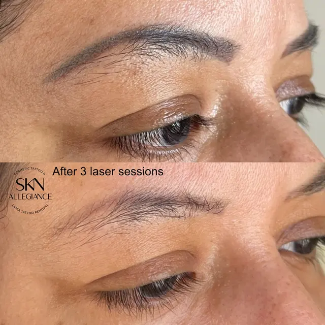 SKN ALLEGIANCE Laser tattoo & Permanent makeup removal — photo from the business 5