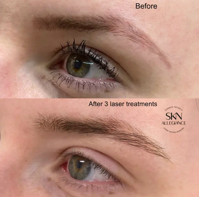 SKN ALLEGIANCE Laser tattoo & Permanent makeup removal — photo from the business 6