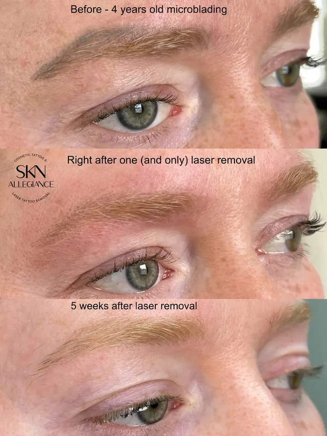 SKN ALLEGIANCE Laser tattoo & Permanent makeup removal — photo from the business 11