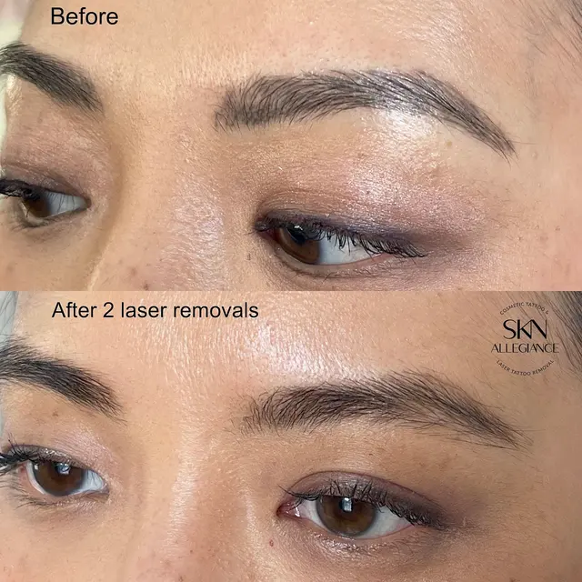 SKN ALLEGIANCE Laser tattoo & Permanent makeup removal — photo from the business 3