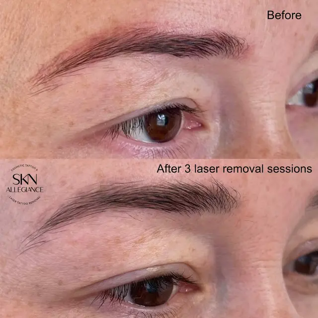 SKN ALLEGIANCE Laser tattoo & Permanent makeup removal — photo from the business 4
