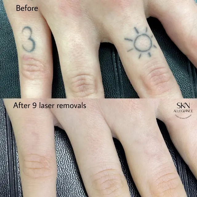 SKN ALLEGIANCE Laser tattoo & Permanent makeup removal — photo from the business 7