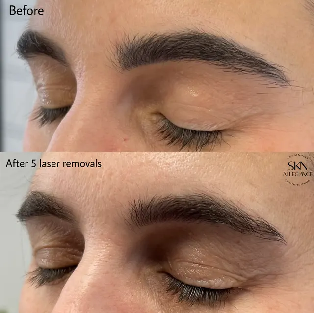 SKN ALLEGIANCE Laser tattoo & Permanent makeup removal — photo from the business 12