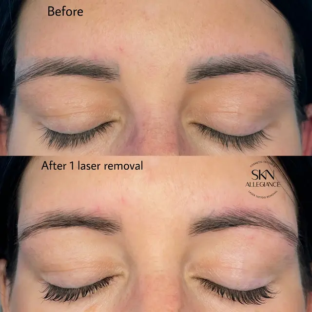 SKN ALLEGIANCE Laser tattoo & Permanent makeup removal — photo from the business 8