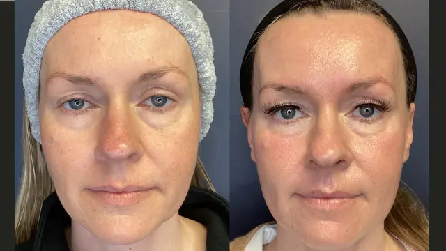 Customer photo of work by Renew MedSpa, from Jennifer Solin's review