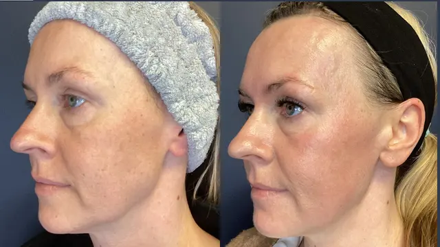 Customer photo of work by Renew MedSpa, from Jennifer Solin's review