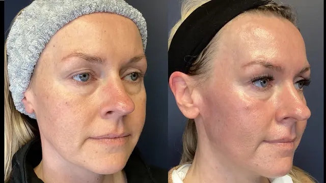 Customer photo of work by Renew MedSpa, from Jennifer Solin's review