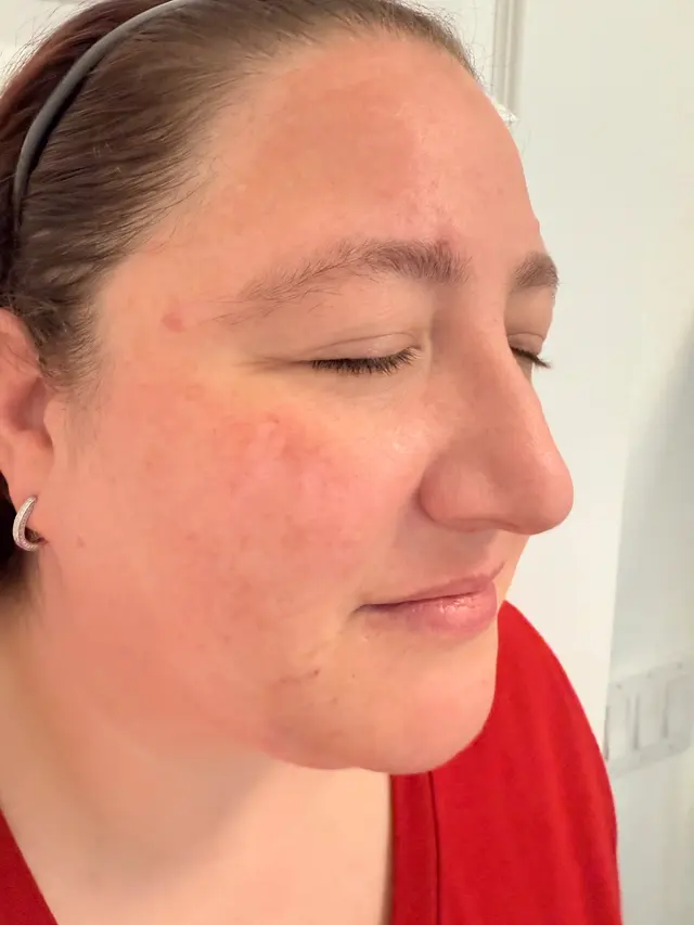 Customer photo of work by Luminous Glow Skin and Laser, from Jessica DeLeonardo's review