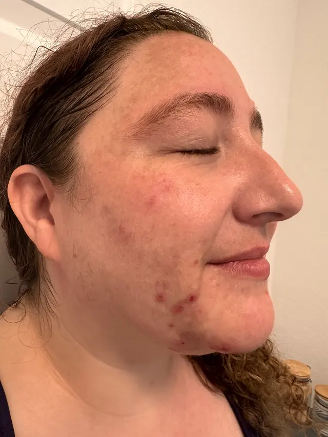 Customer photo of work by Luminous Glow Skin and Laser, from Jessica DeLeonardo's review