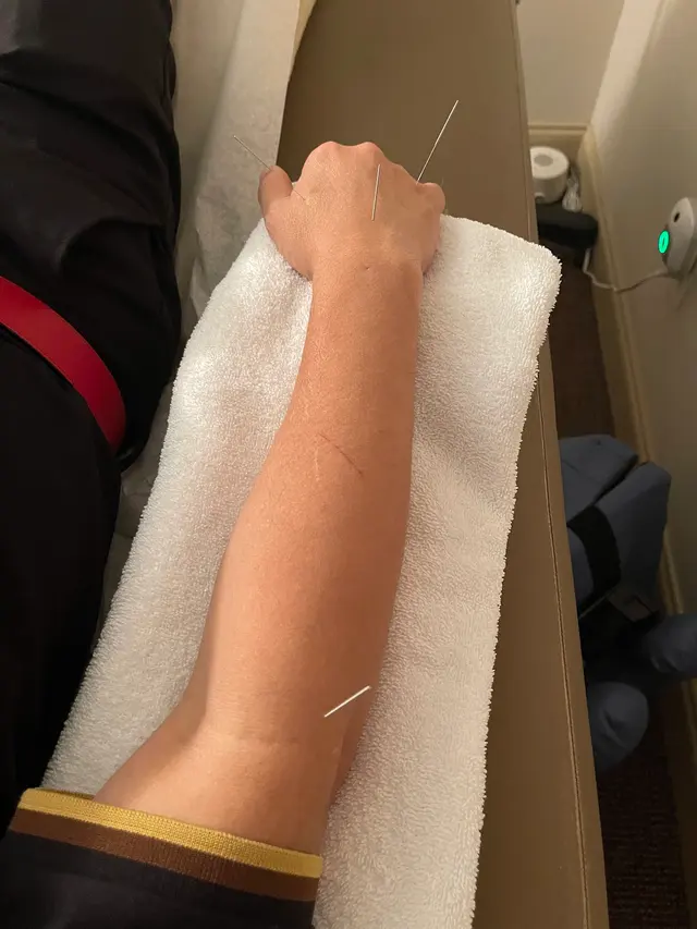 Customer photo of work by Acupuncture Wellness Center LLC, from P J's review
